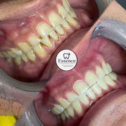 LIMPIEZAS Y BLANQUEAMIENTOS DENTALES - Img 57550298