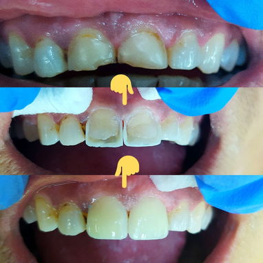 Diseño d sonrisa - 6/10