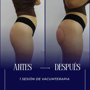 VACUMTERAPIA DE GLÚTEOS CON COPAS COLOMBIANAS EN LA HABANA ¿Quieres mejorar la apariencia de tus glúteos? ✨ En Espa Ch - Img 58078692