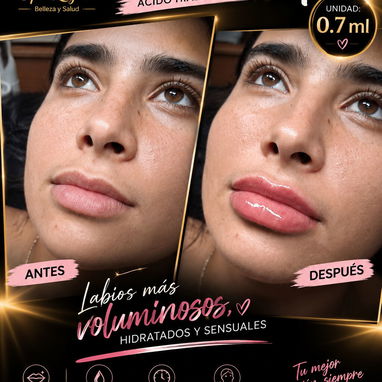 OFERTA EXCLUSIVA CON DESCUENTO DEL 10% EN EL SERVICIO DE ÁCIDO HIALURÓNICO RETICULADO - 2/10