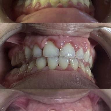Limpiezas y blanqueamientos dentales - Img 122088738