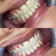 Blanqueamiento Dental Profesional - Img 57684738