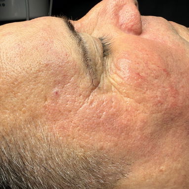 Limpiezas faciales - 2/3