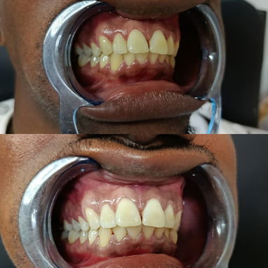 Blanqueamiento Dental - Img 120018246