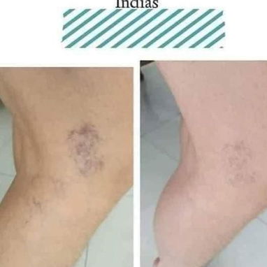 Gel de masaje ideal para mejorar la apariencia de las varices. - Img 121033019