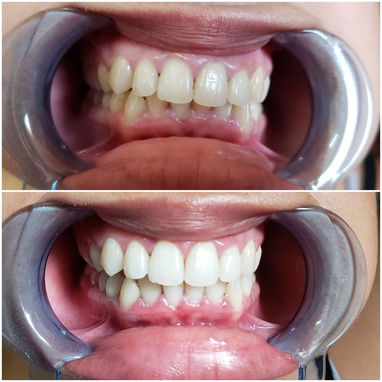Servicio de Limpieza y Blanqueamiento Dental Profesional - Img 118909190
