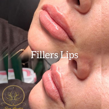 AUMENTO DE LABIOS EN SPA LEYDIS MARIANAO - 3/9