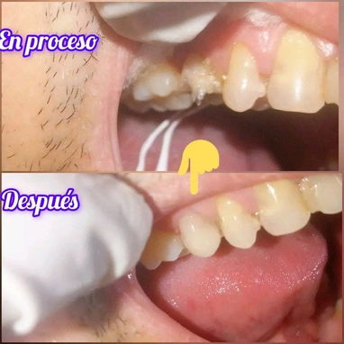 Diseño d sonrisa - 4/10