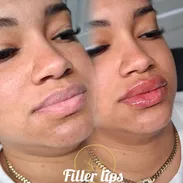 Aumento de labios con ácido hialurónico en Spa_leydis🪷 Marianao - Img 56800174