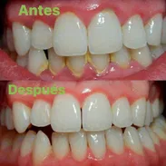 Limpieza dental - Img 52205493