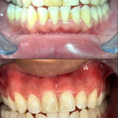 Blanqueamiento y limpieza dental - Img 127132197