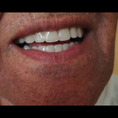 Reparo y conferciono protesis dental acrílicas remobible, garantía, comodidad y estética garantizada - Img 119210763