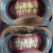 Blanqueamiento Dental Profesional - Img 56269576