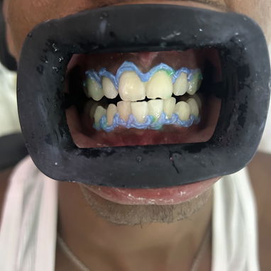 Blanqueamiento dental - Img 125489606