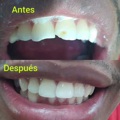 Diseño d sonrisa - 2/10