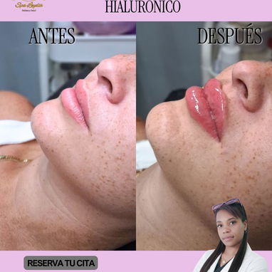 OFERTA DE VERANO EN EL SERVICIO DE ÁCIDO HIALURÓNICO. DESCUENTO DEL 10% - Img 125575823