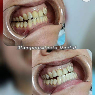 Limpiezas y Blanqueamientos Dentales - Img 119684405