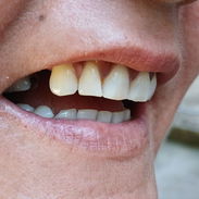 Prótesis Dental parciales y totales removible de acrílico - Img 55665700