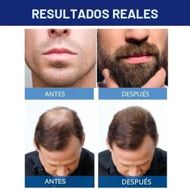 Minoxidil: Tratamiento para el crecimiento del cabello. - Img 119778109