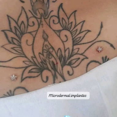 Colocación de microdermal - 3/7