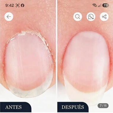 Fuera Uñas Enfermas en Manos y Pies, Lápiz Seralia Anti Hongos - 7/8