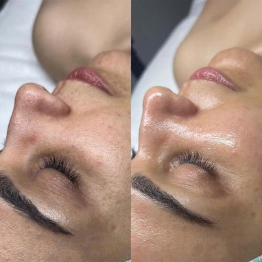 Limpieza Facial | Hidratación | Tratamiento para manchas, acné, lineas de expresión. . - Img 123246749