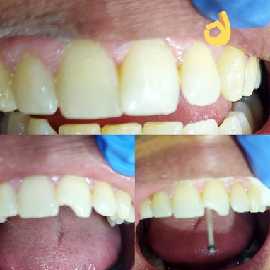 Diseño d sonrisa - 7/10