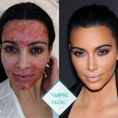 PRP Facial. Medicina Estética para tu eterna juventud - Img 126193423