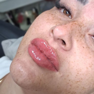 Aumento de labios con ácido hialurónico en Spa_leydis🪷 Marianao. Resalta su belleza de forma natural - Img 128015156