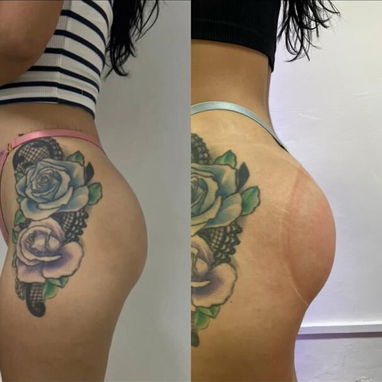 VACUMTERAPIA DE GLÚTEOS CON COPAS COLOMBIANAS EN LA HABANA  ¿Quieres mejorar la apariencia de tus glúteos? ✨  En Espa Ch - 2/3