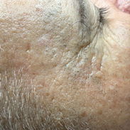 Limpiezas faciales - Img 57690626