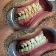 Limpiezas y Blanqueamientos Dentales - Img 55364883