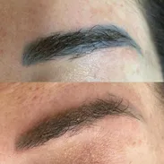 Eliminación de tatuaje con el láser Neatcell 🌟 - Img 52680331