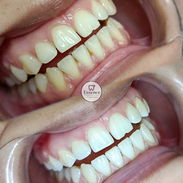 Limpieza y Blanqueamiento Dental Profesional - Img 56826184