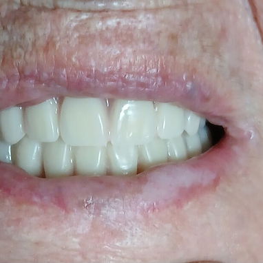 Prótesis Dental parciales y totales removible de acrílico - Img 125960911