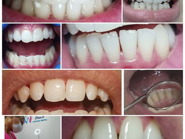 Limpiezas y blanqueamientos dentales realizadas por profesionales - Img 64381253