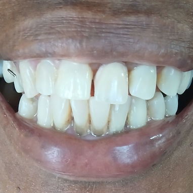 Prótesis Dental parciales y totales removible de acrílico - Img 125960922