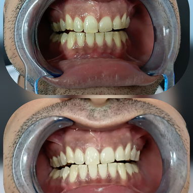 Blanqueamiento Dental Profesional - Img 125462729