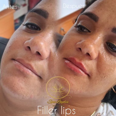 Aumento de labios con ácido hialurónico en Spa_leydis🪷 Marianao. Resalta su belleza de forma natural - Img 128014509