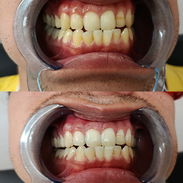 Blanqueamiento Dental Profesional - Img 55771003