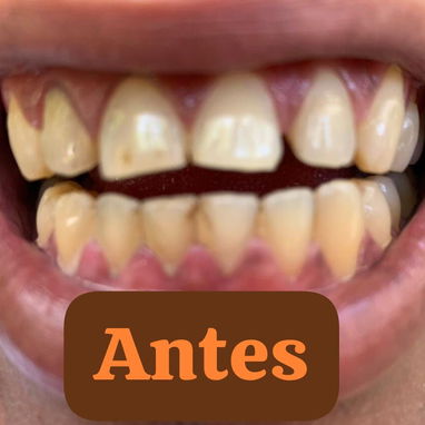 Se realiza limpieza dental y blanqueamiento - Img 124426540