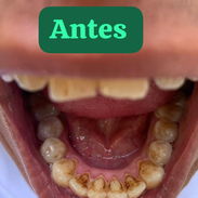 Se realiza limpieza dental y blanqueamiento - Img 56039436