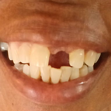 Prótesis Dental parciales y totales removible de acrílico - Img 125960889