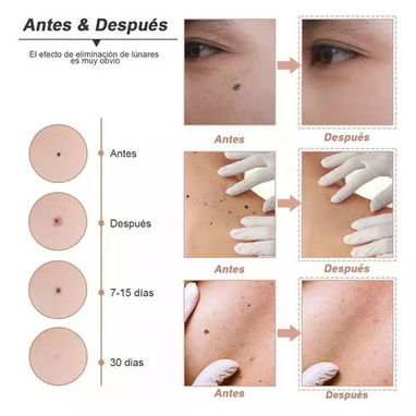 Cauterizador Quita Verrugas, Manchas, Pecas 58757374 - Img 76586245