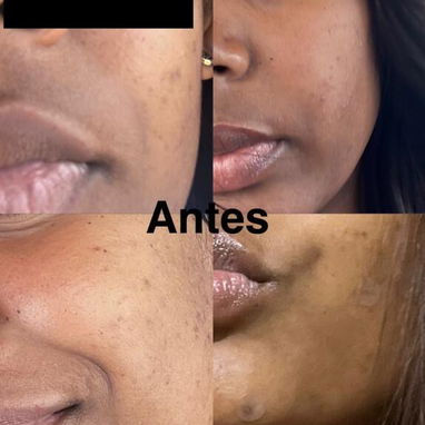 Crema quita manchas Carotone Original - Img 123723606