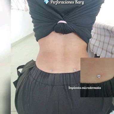 Colocación de microdermal - 2/7