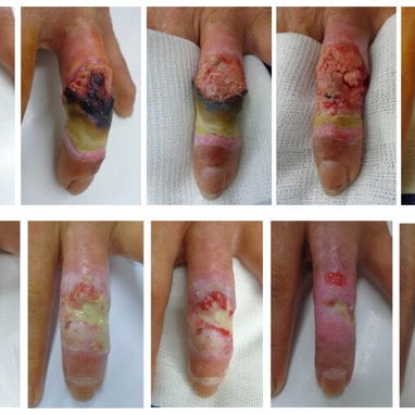 Apósitos de hidrogel para heridas contaminadas, úlceras y Quemaduras - 3/4