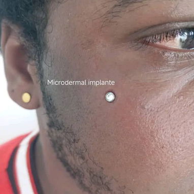 Colocación de microdermal - 4/7