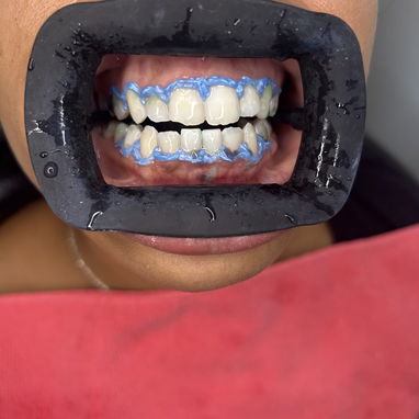 Blanqueamiento y limpieza dental - Img 127131673