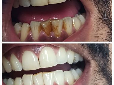 Limpiezas y blanqueamientos dentales realizadas por profesionales,le ayudamos a mejorar su sonrisa - Img 68682857